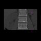 Compression fracture of lumbar vertebra: CT - Computed tomography